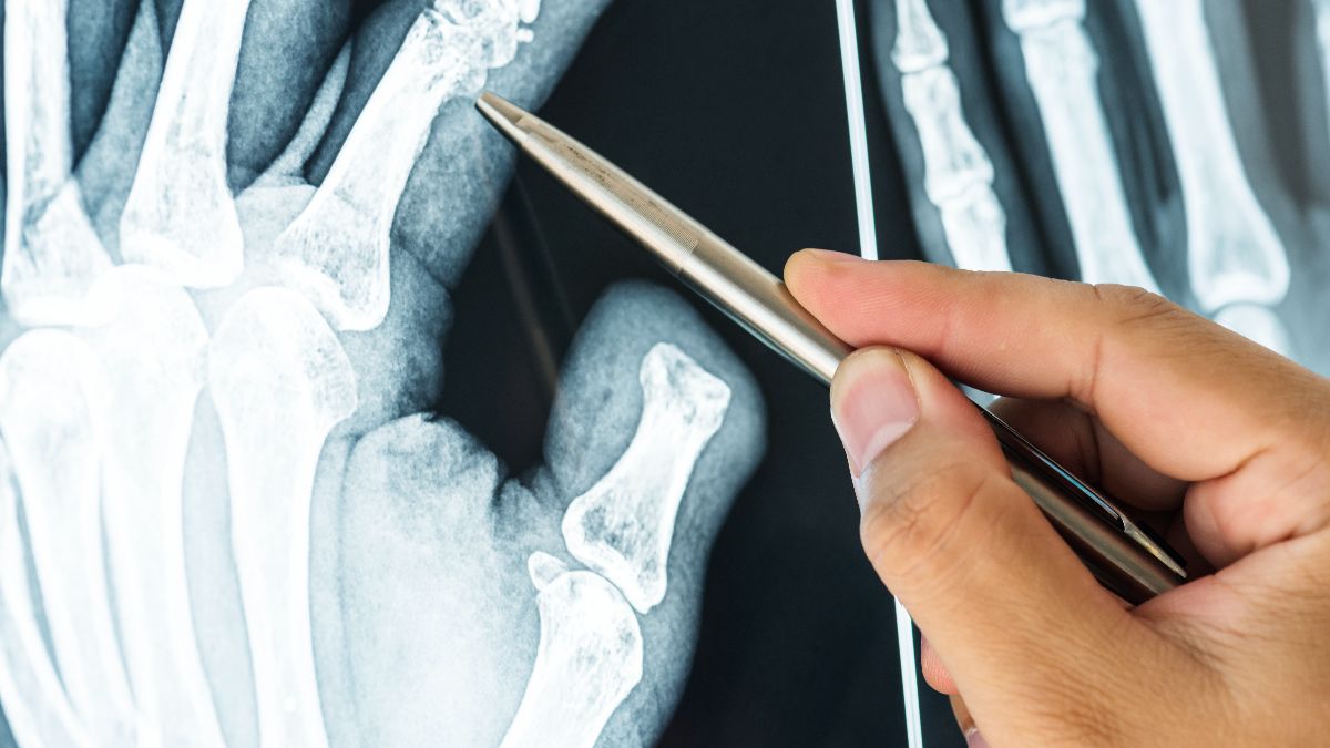 A seamstress receives 25,146.24 euros for permanent partial disability after being on sick leave for 545 days due to osteoarthritis in the thumb